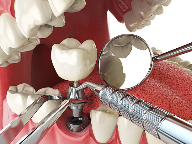 Best Knocked-Out Tooth (Avulsed Tooth) Treatment in Old Miakka, FL